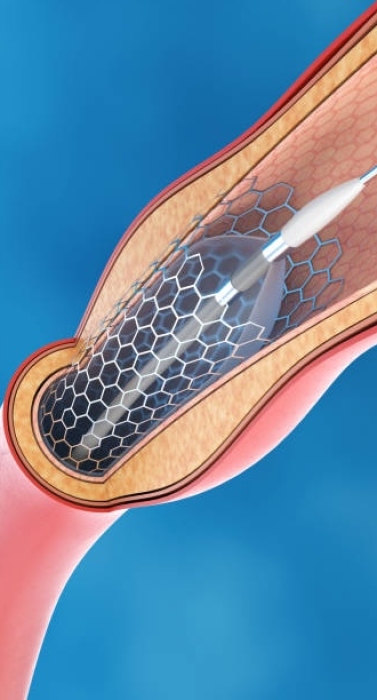 Stent Implantation for Blood Circulation